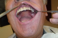 Teilprothese Oberkiefer